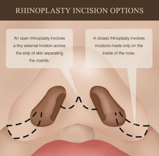 illustration showing rhinoplasty incision options